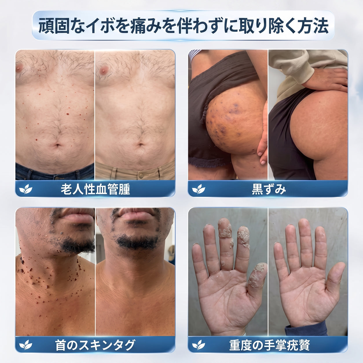 薬剤師もおすすめ💕 Hiskin® 7日間 タグ＆スポットイレーサー🪄 （痛みゼロ・傷あとゼロを目指すローラーボールタイプ）👩‍⚕️