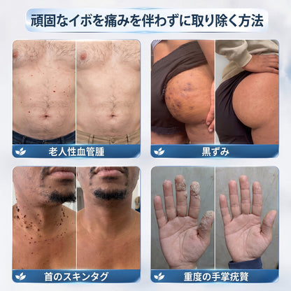 薬剤師もおすすめ💕 Hiskin® 7日間 タグ＆スポットイレーサー🪄 （痛みゼロ・傷あとゼロを目指すローラーボールタイプ）👩‍⚕️