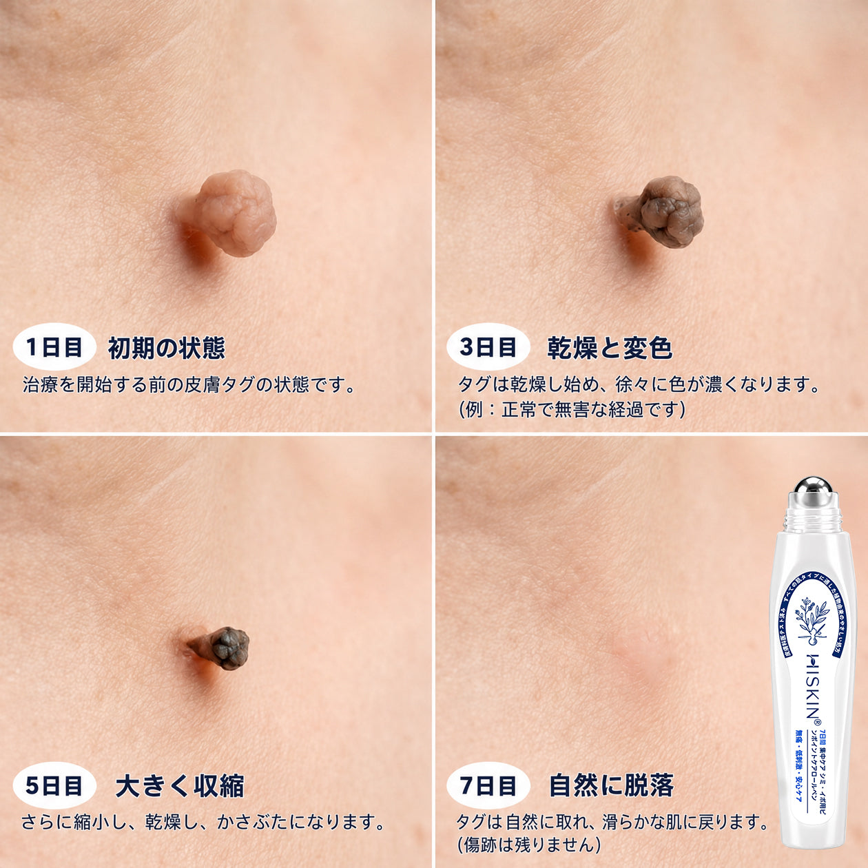 薬剤師もおすすめ💕 Hiskin® 7日間 タグ＆スポットイレーサー🪄 （痛みゼロ・傷あとゼロを目指すローラーボールタイプ）👩‍⚕️