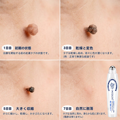 薬剤師もおすすめ💕 Hiskin® 7日間 タグ＆スポットイレーサー🪄 （痛みゼロ・傷あとゼロを目指すローラーボールタイプ）👩‍⚕️